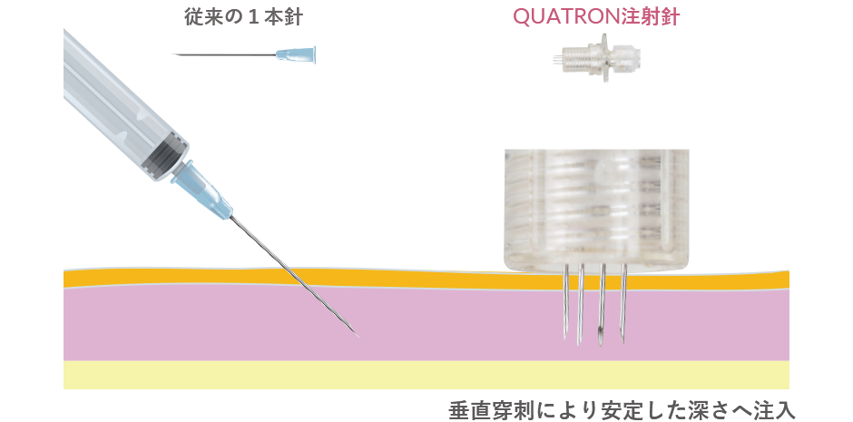 穿刺深さのコントロール